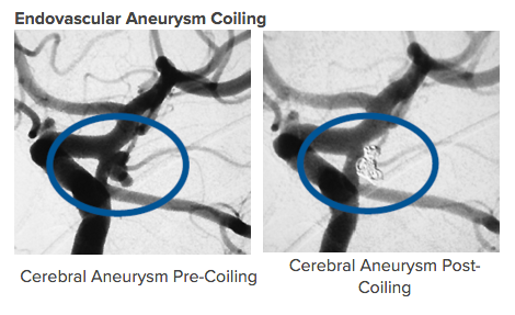 Aneurysms Coiling Aneurysms Coiling