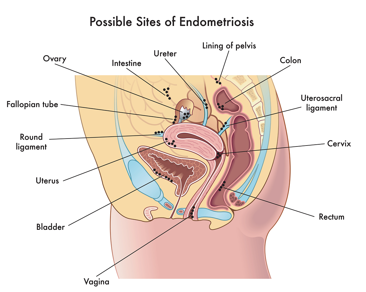 Image shows places where endometriosis tissues may grow, including reproductive organs, bladder, ureters, rectum, colon, intestines and other structures in the pelvis.